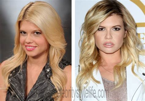 chanel west coast plastic surgery.